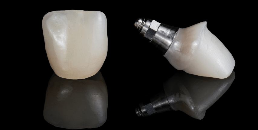 Seven corners family dentistry dental implant crown restoration