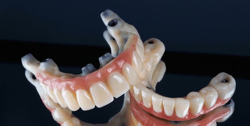 Seven corners family dentistry dental implant supported dentures